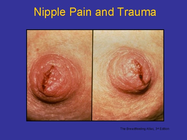 Nipple Pain and Trauma The Breastfeeding Atlas, 3 rd Edition Nipple Pain and Trauma The Breastfeeding Atlas, 3 rd Edition
