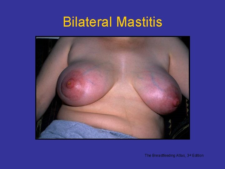 Bilateral Mastitis The Breastfeeding Atlas, 3 rd Edition Bilateral Mastitis The Breastfeeding Atlas, 3 rd Edition