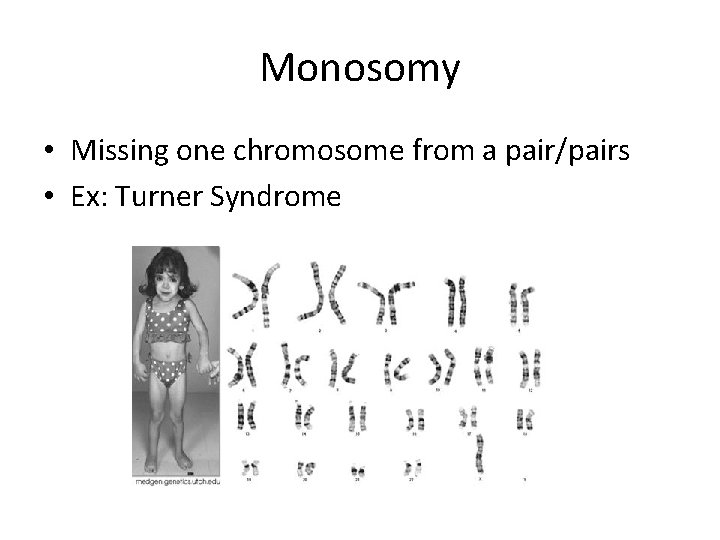 Monosomy • Missing one chromosome from a pair/pairs • Ex: Turner Syndrome 