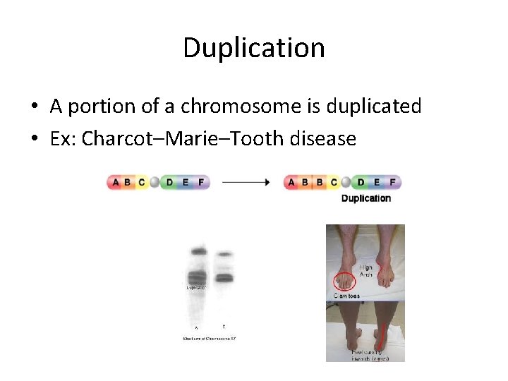 Duplication • A portion of a chromosome is duplicated • Ex: Charcot–Marie–Tooth disease 