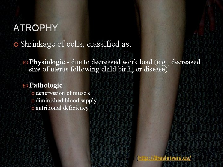 ATROPHY Shrinkage of cells, classified as: Physiologic - due to decreased work load (e.