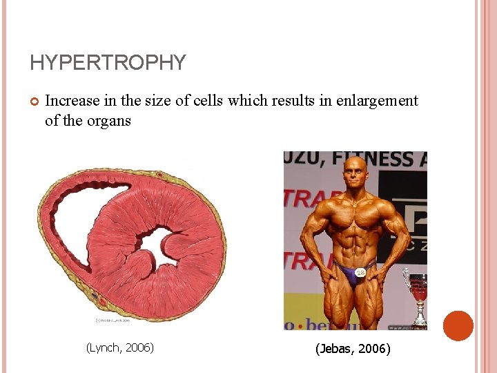 HYPERTROPHY Increase in the size of cells which results in enlargement of the organs