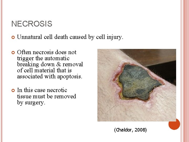 NECROSIS Unnatural cell death caused by cell injury. Often necrosis does not trigger the