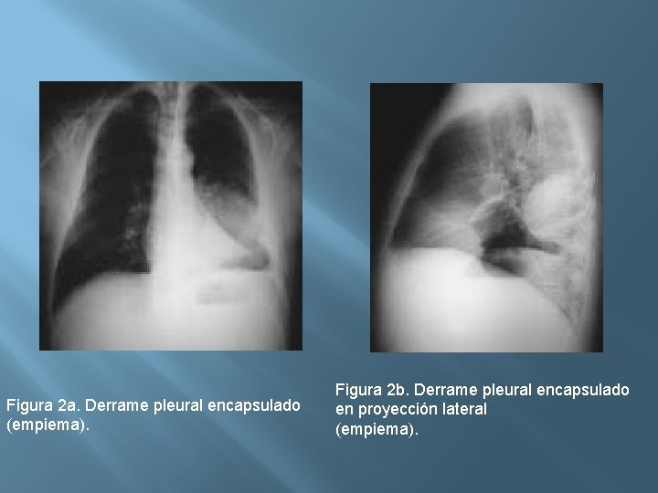 Figura 2 a. Derrame pleural encapsulado (empiema). Figura 2 b. Derrame pleural encapsulado en