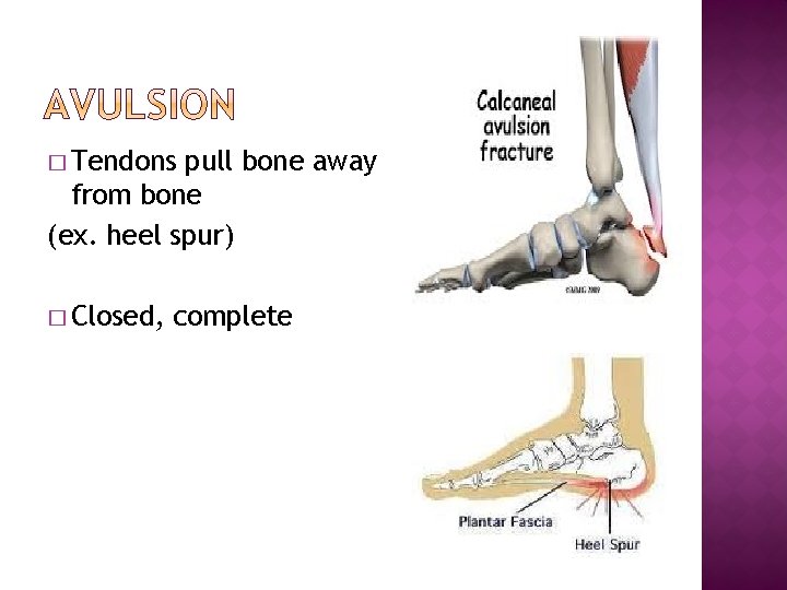 � Tendons pull bone away from bone (ex. heel spur) � Closed, complete 