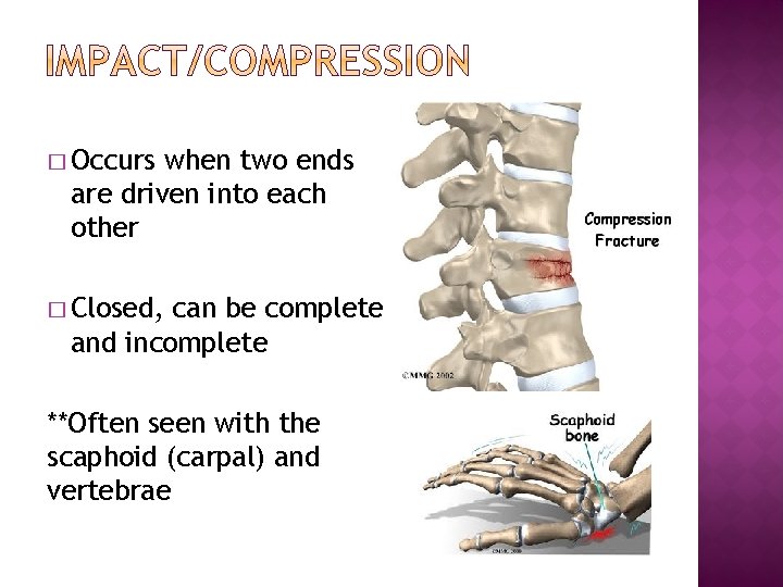 � Occurs when two ends are driven into each other � Closed, can be