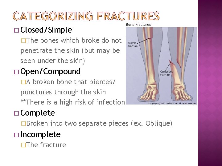 � Closed/Simple �The bones which broke do not penetrate the skin (but may be