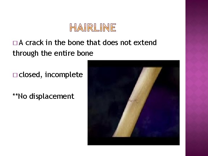 �A crack in the bone that does not extend through the entire bone �