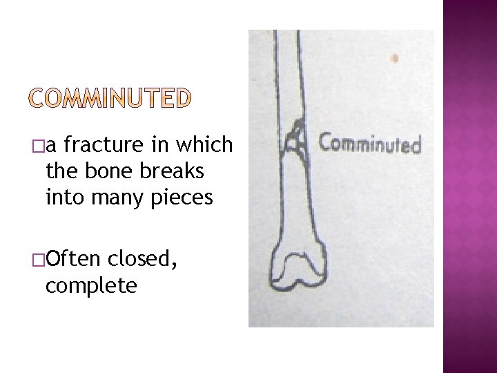 �a fracture in which the bone breaks into many pieces �Often closed, complete 