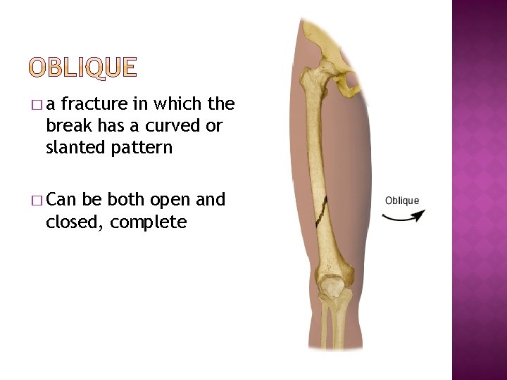 �a fracture in which the break has a curved or slanted pattern � Can