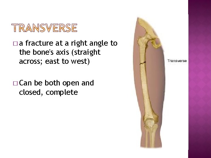 �a fracture at a right angle to the bone's axis (straight across; east to