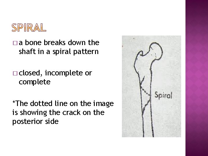 �a bone breaks down the shaft in a spiral pattern � closed, incomplete or