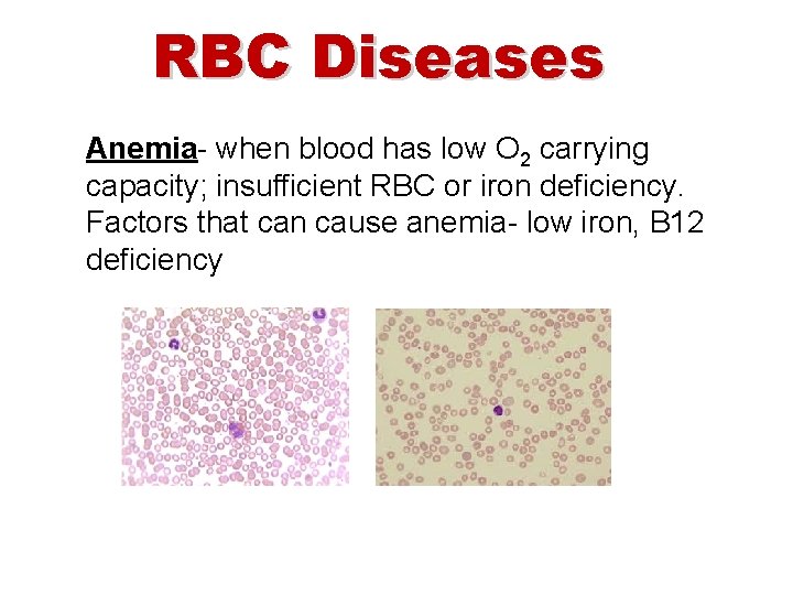 RBC Diseases Anemia- when blood has low O 2 carrying capacity; insufficient RBC or