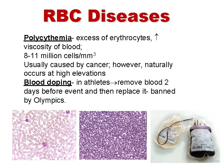 RBC Diseases Polycythemia- excess of erythrocytes, viscosity of blood; 8 -11 million cells/mm 3