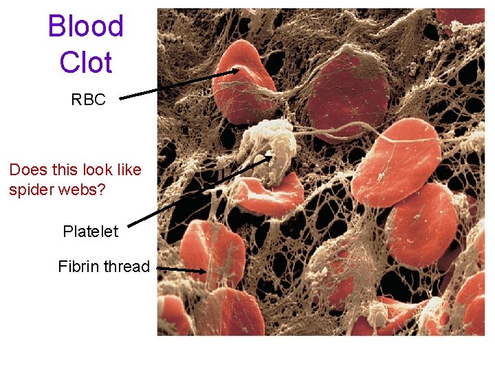 Blood Clot RBC Does this look like spider webs? Platelet Fibrin thread 
