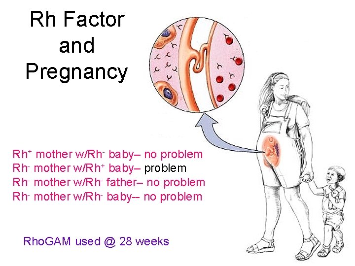 Rh Factor and Pregnancy Rh+ mother w/Rh- baby– no problem Rh- mother w/Rh+ baby–