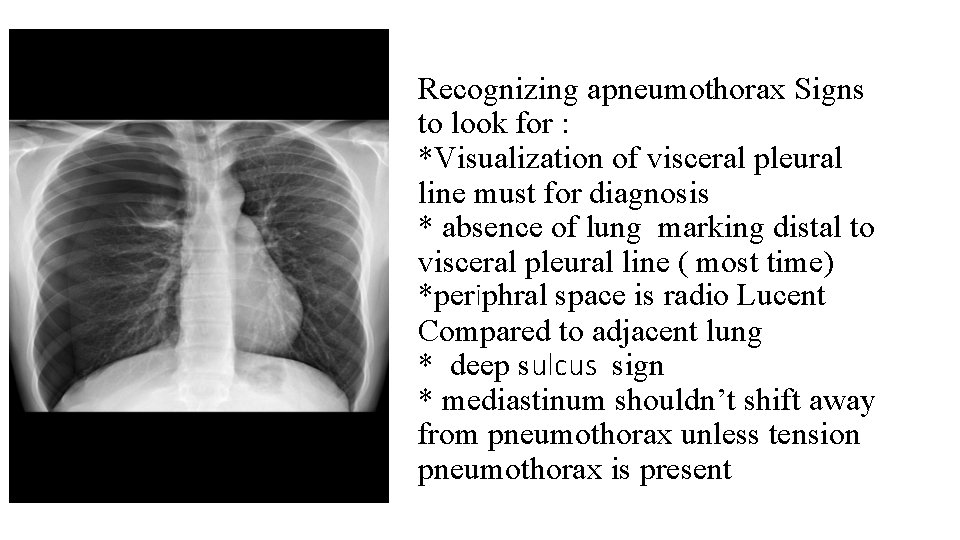 Recognizing apneumothorax Signs to look for : *Visualization of visceral pleural line must for