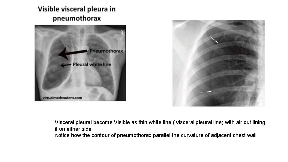 Visceral pleural become Visible as thin white line ( visceral pleural line) with air