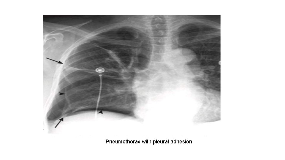Pneumothorax with pleural adhesion 