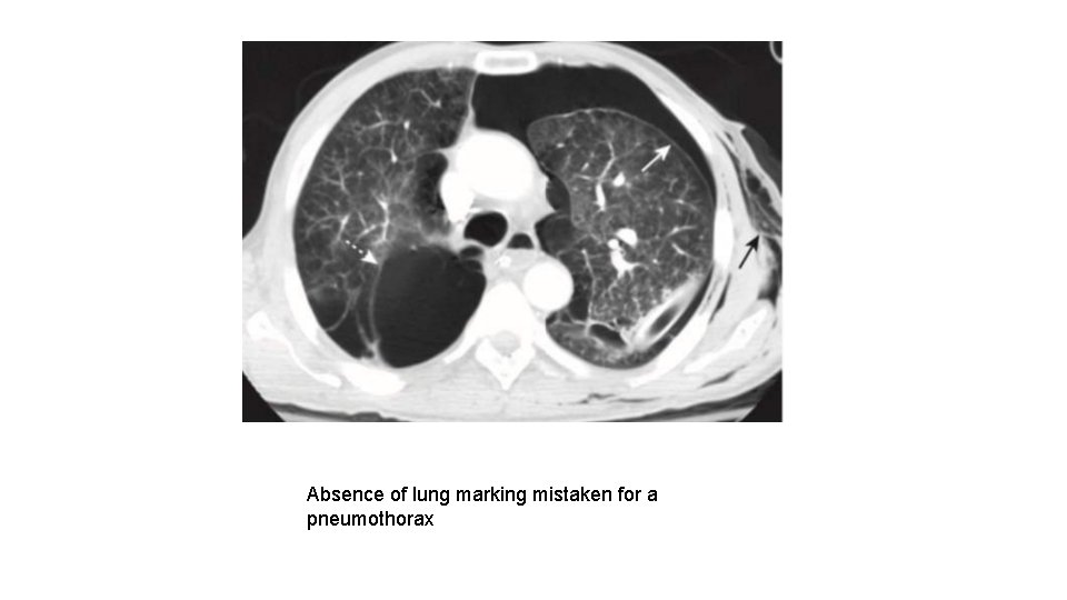 Absence of lung marking mistaken for a pneumothorax 