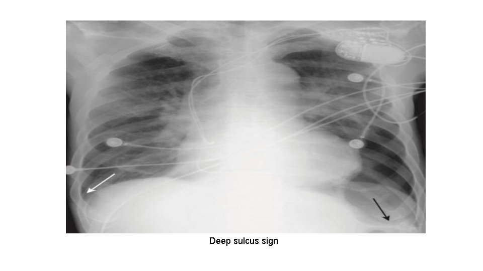 Deep sulcus sign 