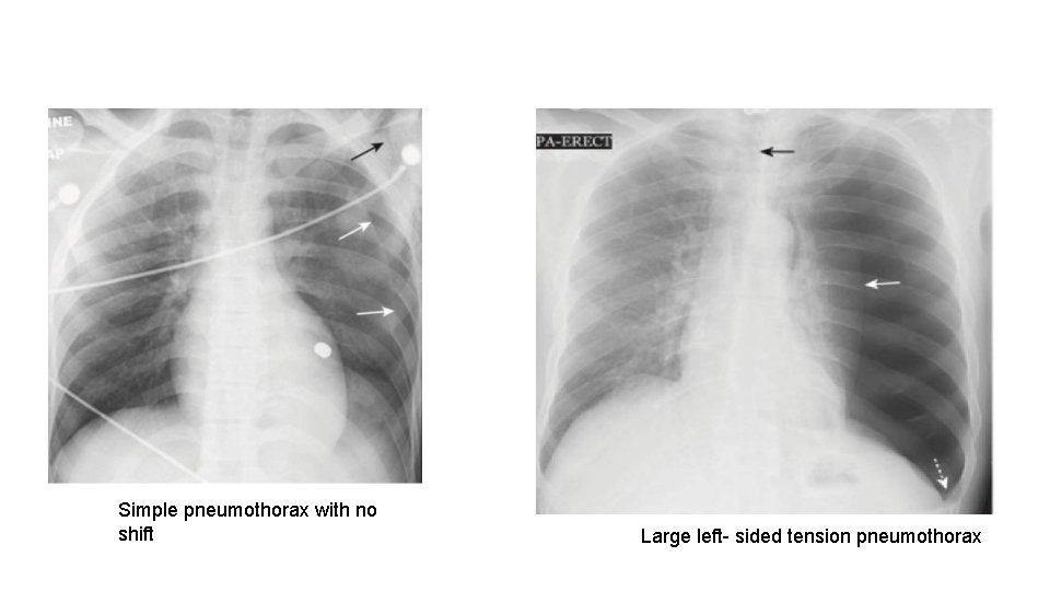 Simple pneumothorax with no shift Large left- sided tension pneumothorax 