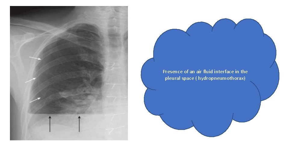Presence of an air fluid interface in the pleural space ( hydropneumothorax) 