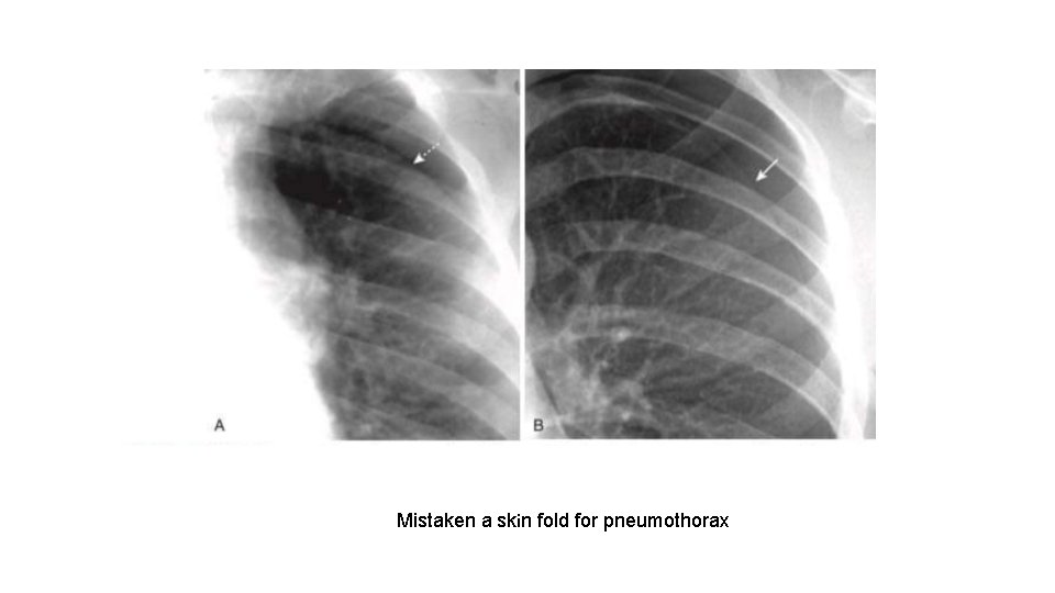 Mistaken a skin fold for pneumothorax 