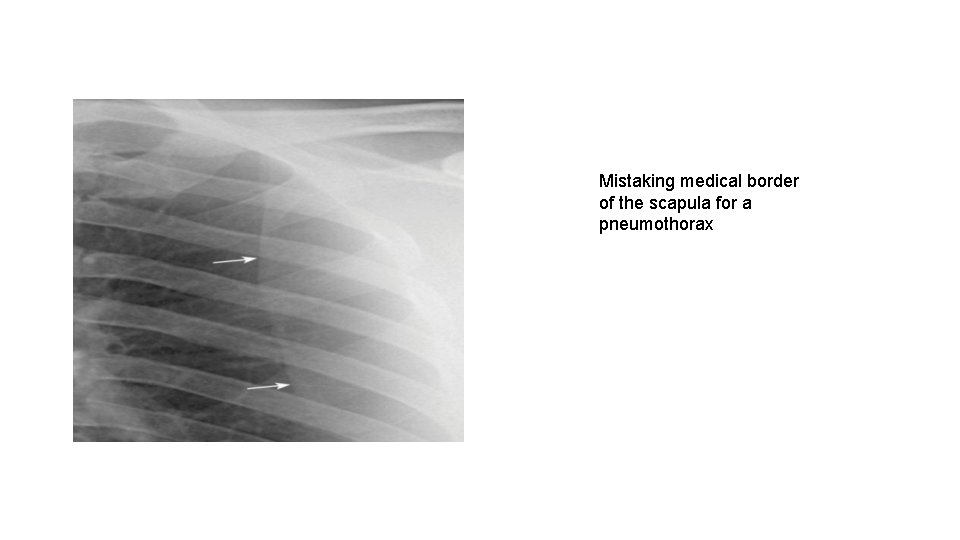 Mistaking medical border of the scapula for a pneumothorax 