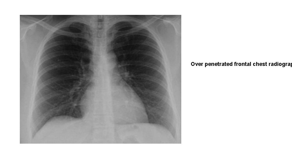 Over penetrated frontal chest radiograp 