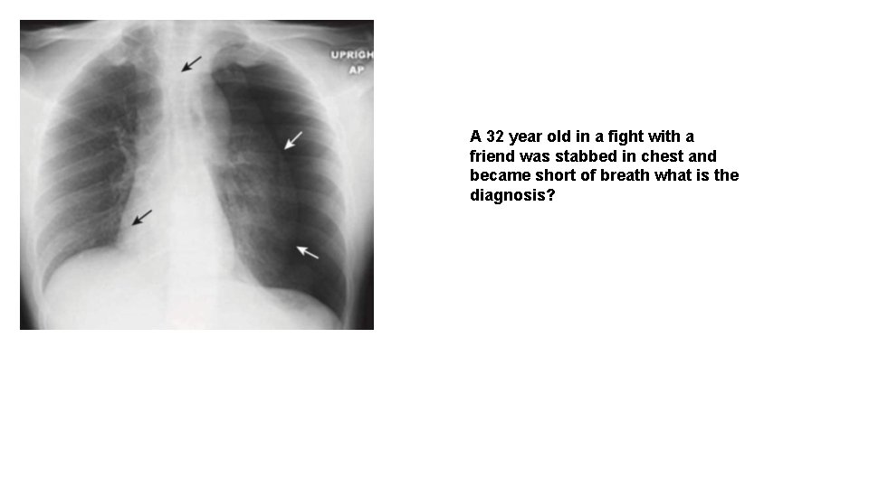 A 32 year old in a fight with a friend was stabbed in chest