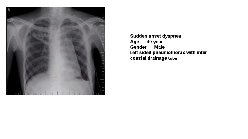 Sudden onset dyspnea Age 40 year Gender Male Left sided pneumothorax with inter coastal