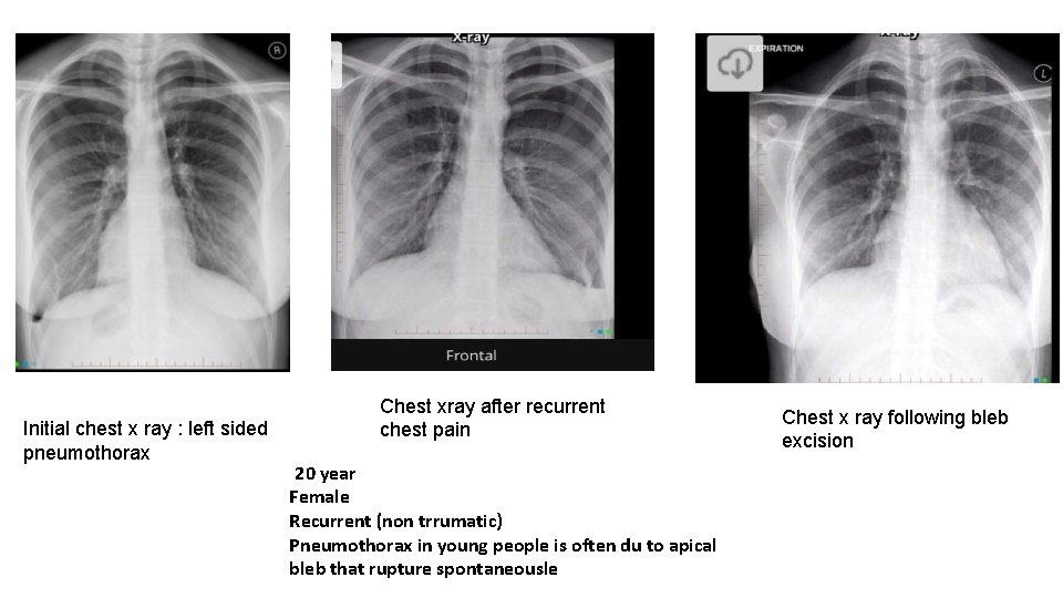Initial chest x ray : left sided pneumothorax Chest xray after recurrent chest pain