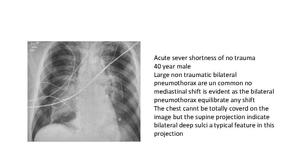 Acute sever shortness of no trauma 40 year male Large non traumatic bilateral pneumothorax