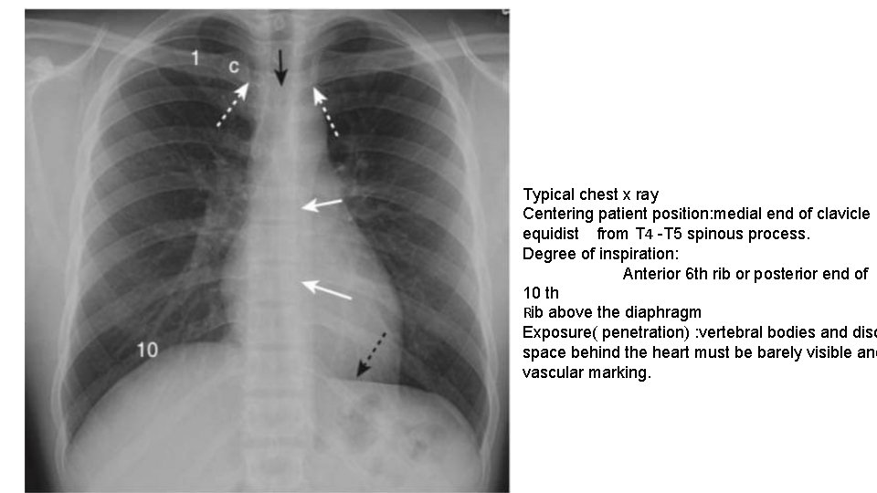 Typical chest x ray Centering patient position: medial end of clavicle equidist from T