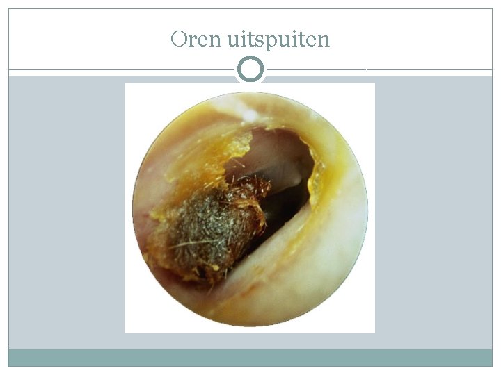 Oren uitspuiten 