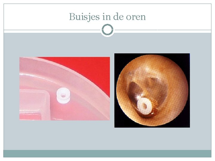 Buisjes in de oren 