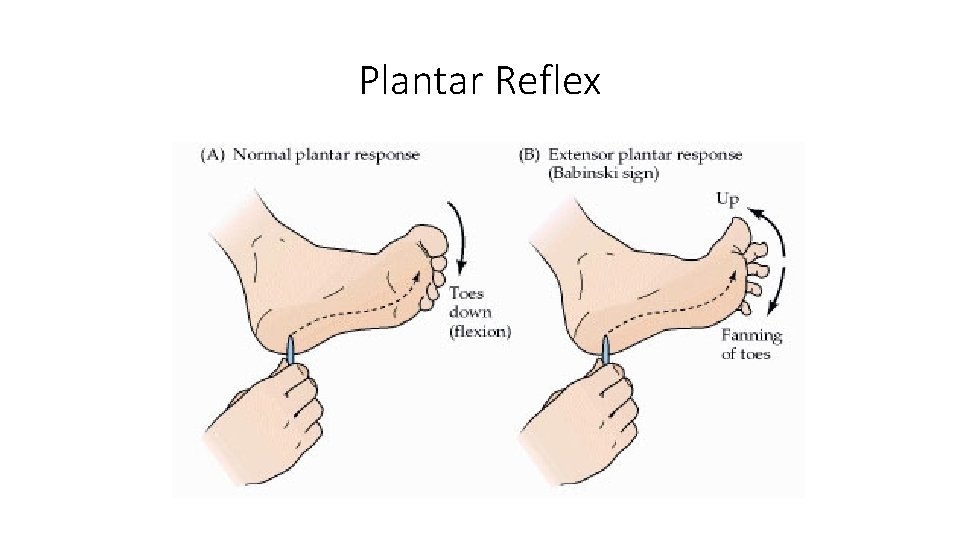 Plantar Reflex  Plantar Reflex