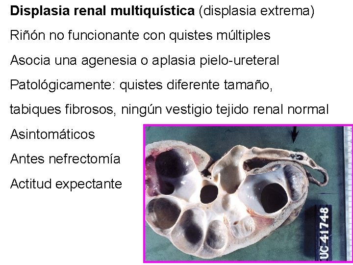 Displasia renal multiquística (displasia extrema) Riñón no funcionante con quistes múltiples Asocia una agenesia