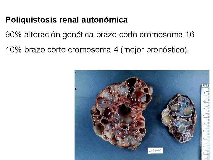 Poliquistosis renal autonómica 90% alteración genética brazo corto cromosoma 16 10% brazo corto cromosoma