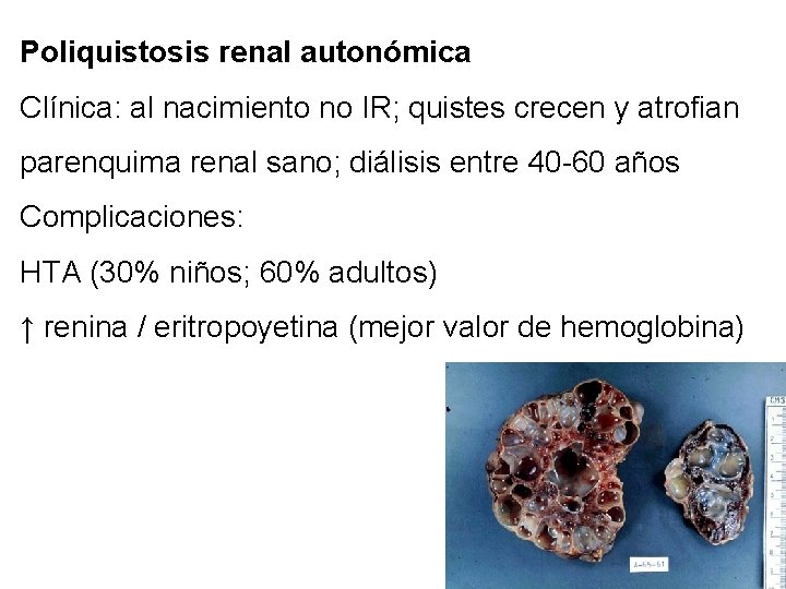 Poliquistosis renal autonómica Clínica: al nacimiento no IR; quistes crecen y atrofian parenquima renal