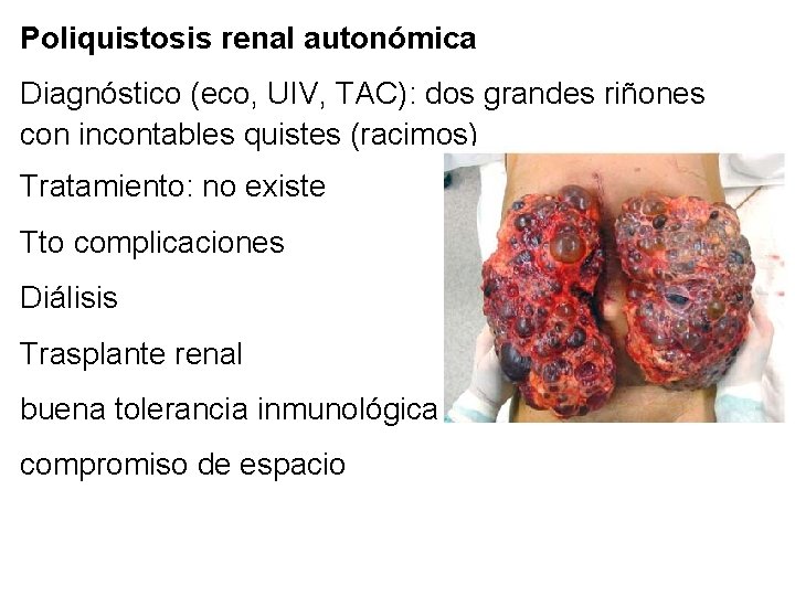 Poliquistosis renal autonómica Diagnóstico (eco, UIV, TAC): dos grandes riñones con incontables quistes (racimos)