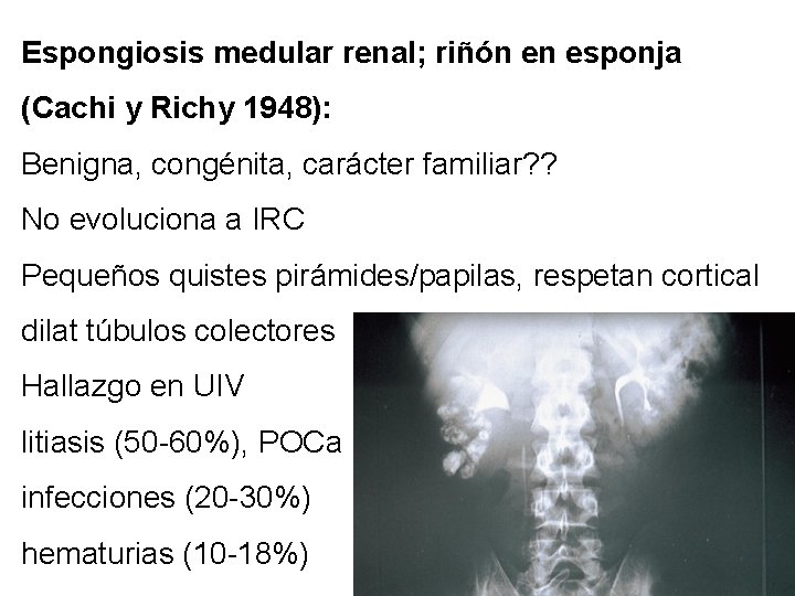 Espongiosis medular renal; riñón en esponja (Cachi y Richy 1948): Benigna, congénita, carácter familiar?