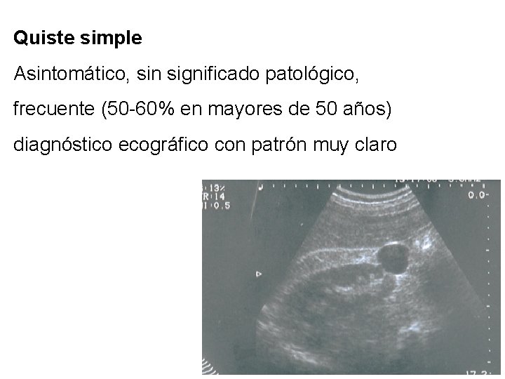 Quiste simple Asintomático, sin significado patológico, frecuente (50 -60% en mayores de 50 años)