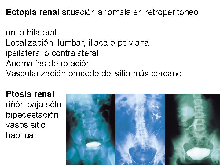 Ectopia renal situación anómala en retroperitoneo uni o bilateral Localización: lumbar, iliaca o pelviana