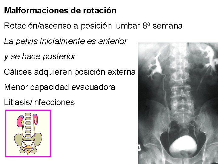 Malformaciones de rotación Rotación/ascenso a posición lumbar 8ª semana La pelvis inicialmente es anterior