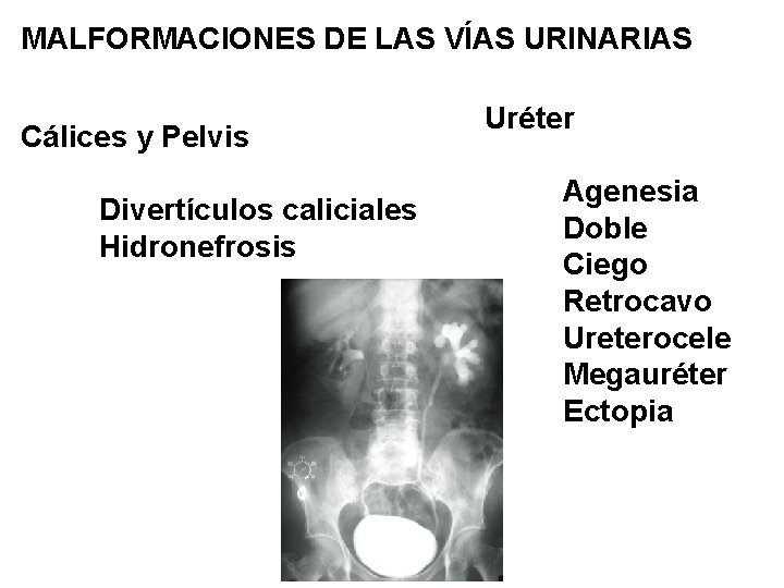 MALFORMACIONES DE LAS VÍAS URINARIAS Cálices y Pelvis Divertículos caliciales Hidronefrosis Uréter Agenesia Doble