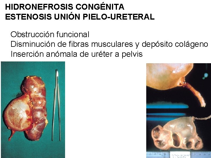 HIDRONEFROSIS CONGÉNITA ESTENOSIS UNIÓN PIELO-URETERAL Obstrucción funcional Disminución de fibras musculares y depósito colágeno