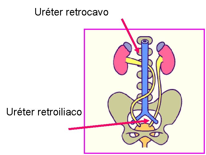 Uréter retrocavo Uréter retroiliaco 