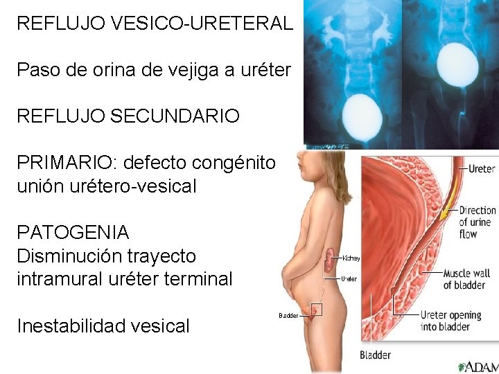 REFLUJO VESICO-URETERAL Paso de orina de vejiga a uréter REFLUJO SECUNDARIO PRIMARIO: defecto congénito